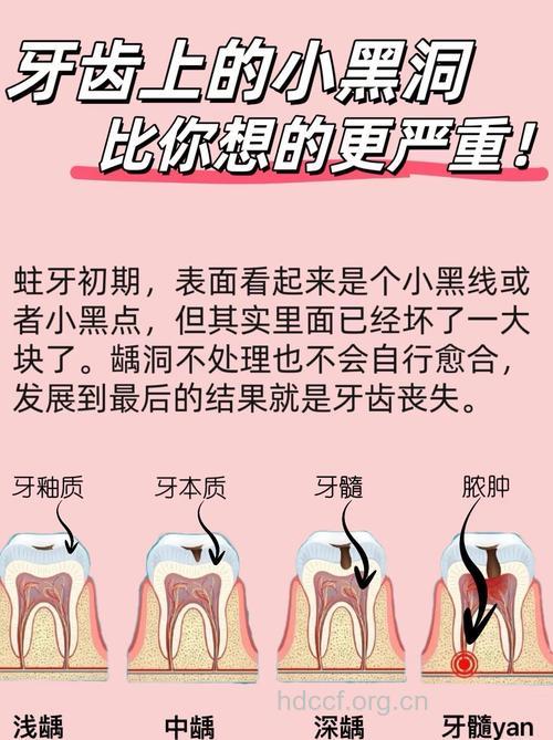 蛀牙小洞不补 大洞伤牙神经