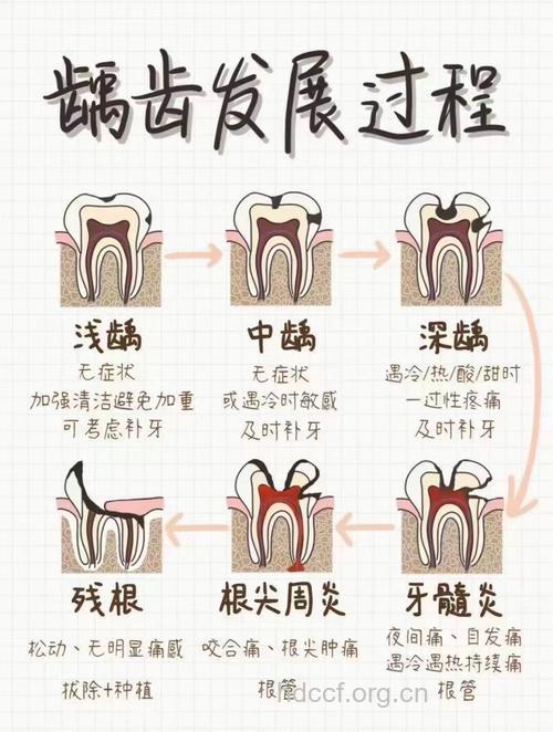 怎样的蛀牙要拔牙