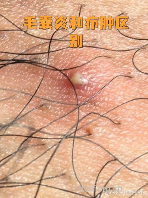 毛囊炎和疖子是一种病吗
