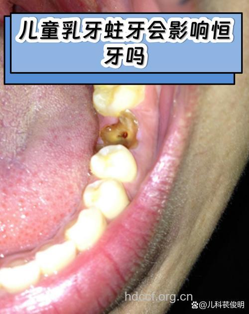 宝宝乳牙蛀牙有关系吗