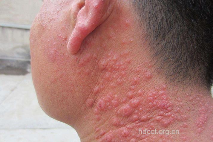 什么是多形性日光疹疾病