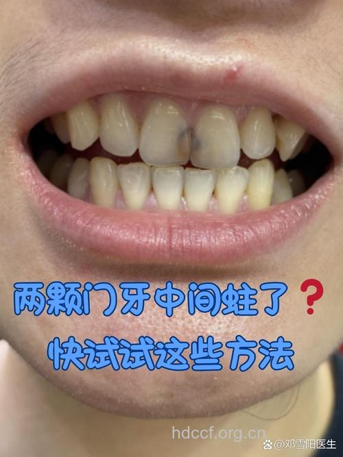 门牙蛀牙了怎么办