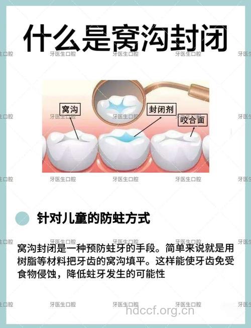 预防孩子蛀牙最有效的方法——窝沟封闭