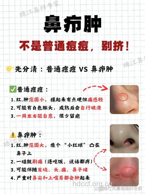 为何鼻疖不可妄行挤压