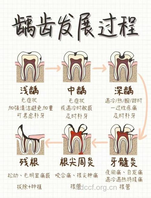 一颗牙齿的蛀牙过程