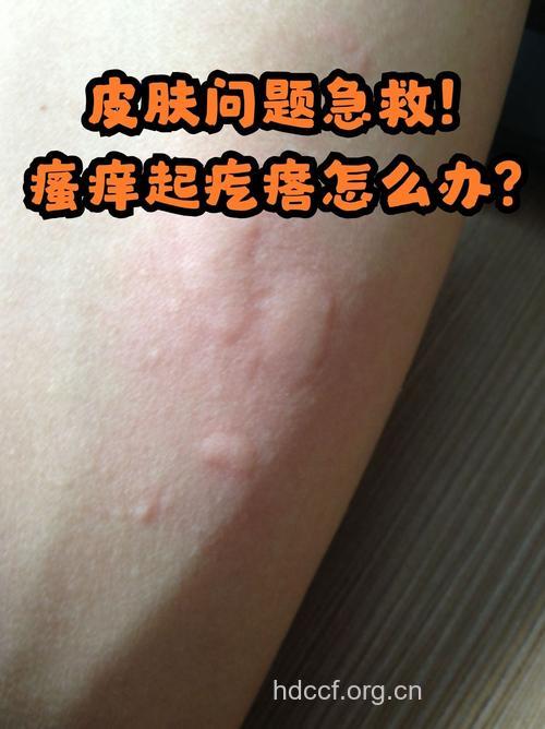 荨麻疹易反复且越挠越痒