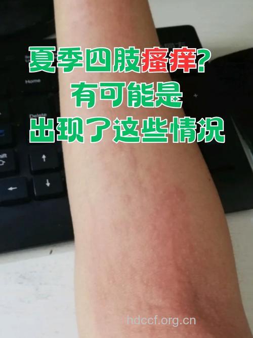 莫名奇痒竟是出汗惹的祸