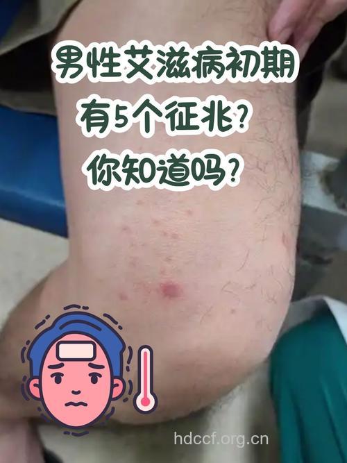 为您详细介绍艾滋病的症状