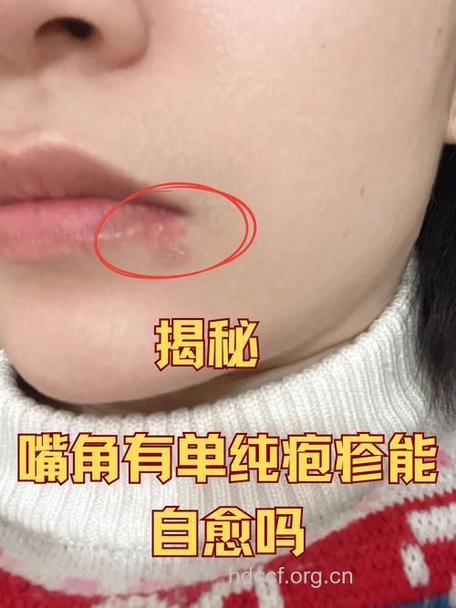 口唇单纯疱疹的注意事项
