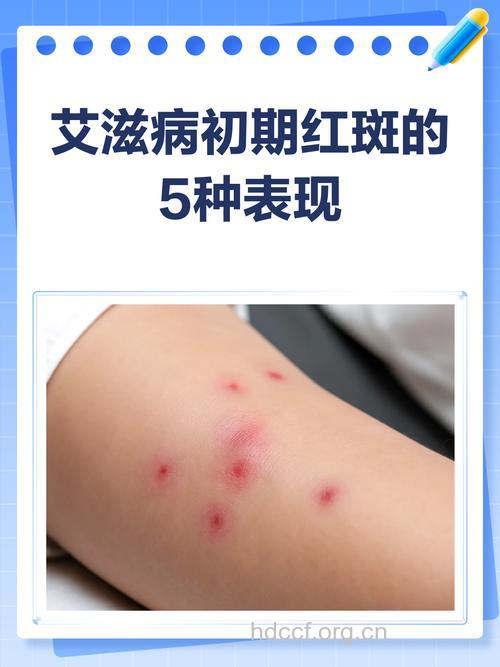 艾滋病早期症状