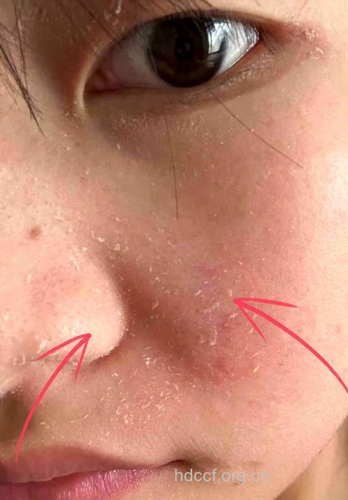 化妆品中香料最易导致化妆品皮炎