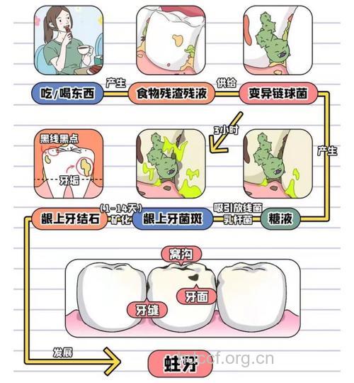 蛀牙形成的四个条件
