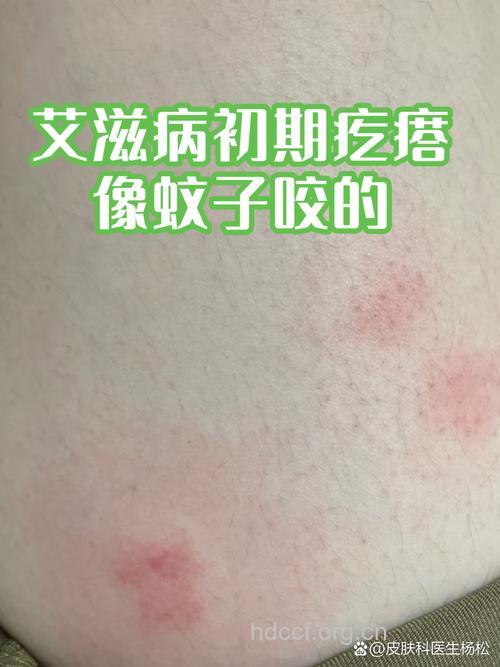 蚊叮虫咬会否传染艾滋病