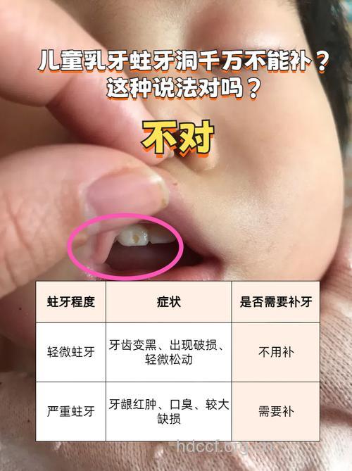 警惕孩子的乳牙被蛀需要补