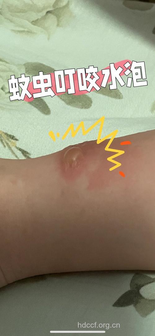 蚊虫叮咬当心传染性脓疱疮