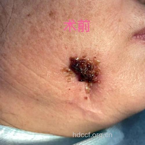蛀牙化脓可腐蚀骨头 导致下巴穿孔