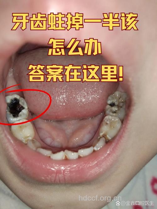 蛀牙的缺失可导致面瘫