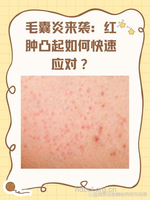 夏天久坐不动 警惕毛囊发炎