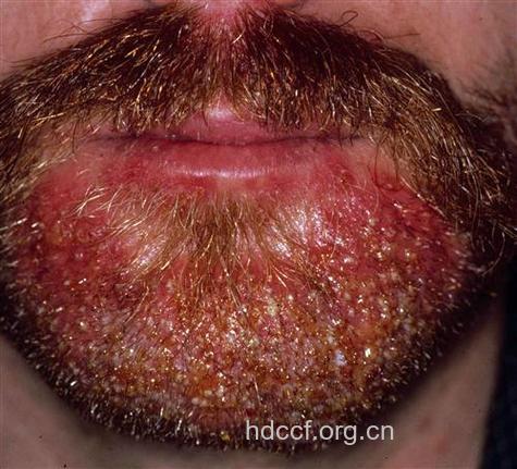 男性剃须不正确易患毛囊炎