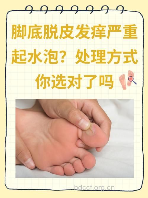 脚底脱皮起水泡是怎么回事