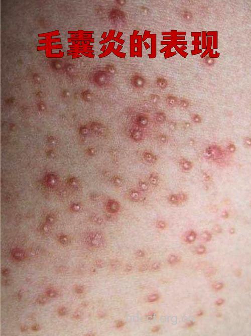 得了毛囊炎会出现哪些症状