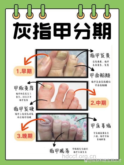 民间小偏方治疗灰指甲