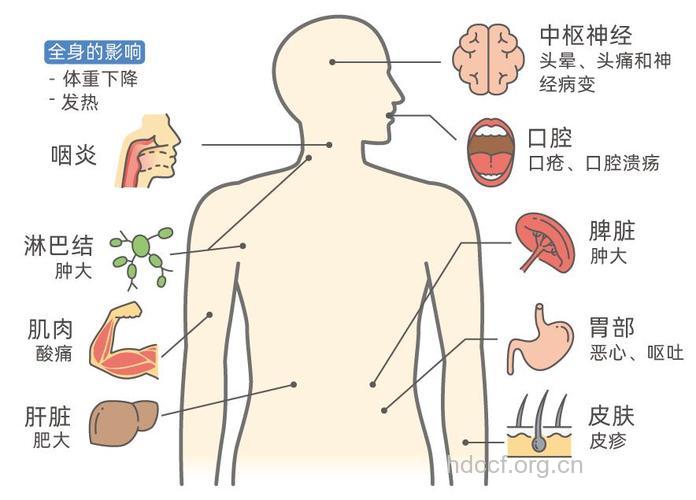 艾滋病病毒进入人体后躲在哪里?