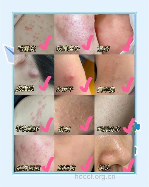 面部毛囊炎应该怎样治疗