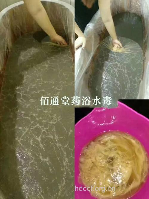 治疗鱼鳞病的中医偏方