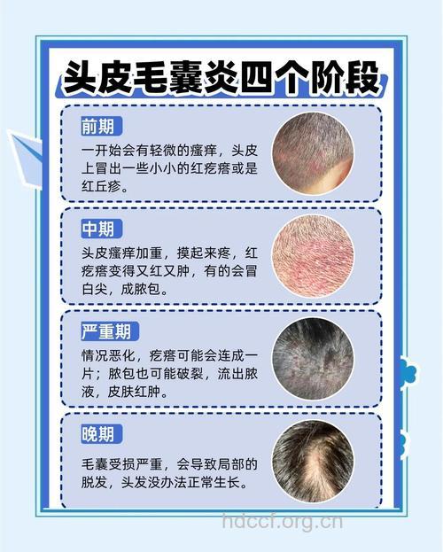 头皮毛囊炎的危害有哪些