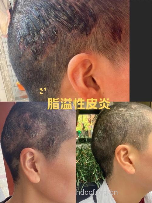 脂溢性皮炎传染吗