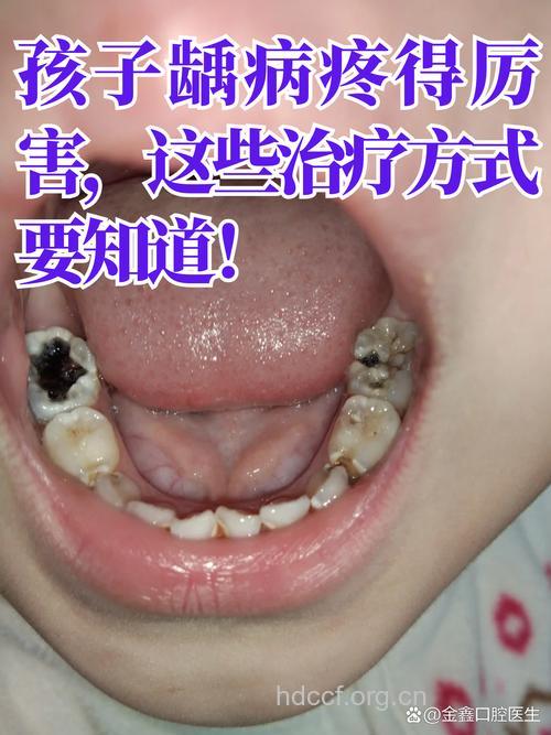 母亲吸烟孩子易患蛀牙