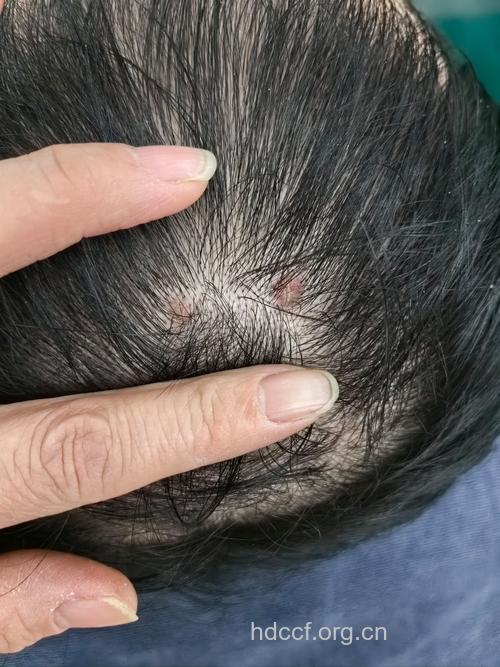 头皮毛囊炎会传染吗
