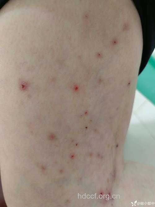 成人痒疹的症状图