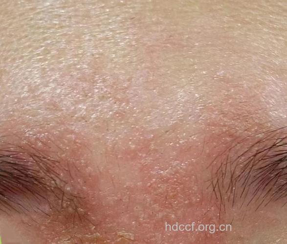 干性脂溢性皮炎有什么症状