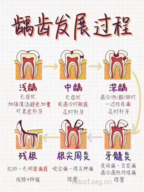 关于龋齿病变有哪些类型