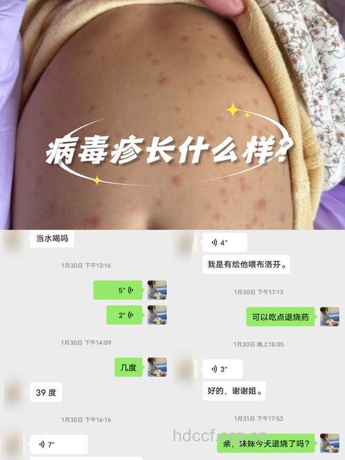 病毒性皮肤病的临床表现