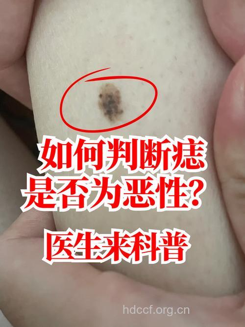 可能癌变的痣有哪些