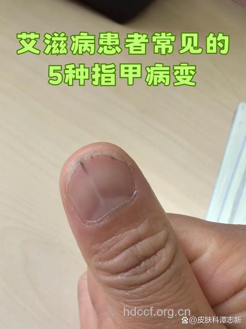 警惕:修指甲也会传染艾滋病