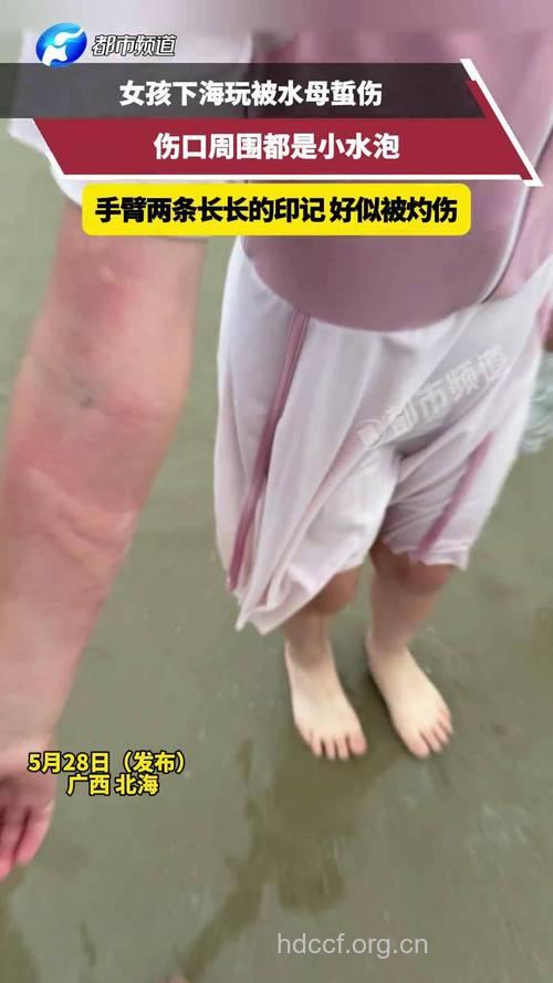 夏季游泳小心海蜇皮炎