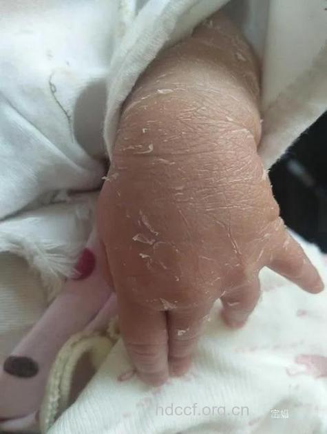 新生儿40%皮肤缺失四肢肌肉外露
