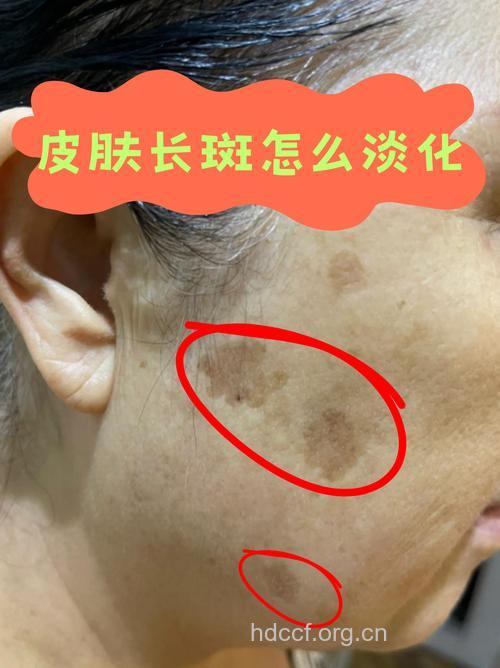 电脑辐射小心引发“老年斑”