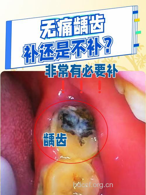 “冰美人”原来患了蛀牙