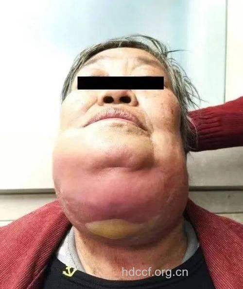 牙病不早治小心会毁容