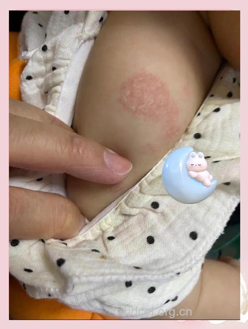 婴儿干燥性湿疹先润肤
