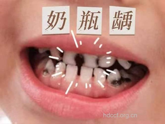 喝酸奶过量易得蛀牙