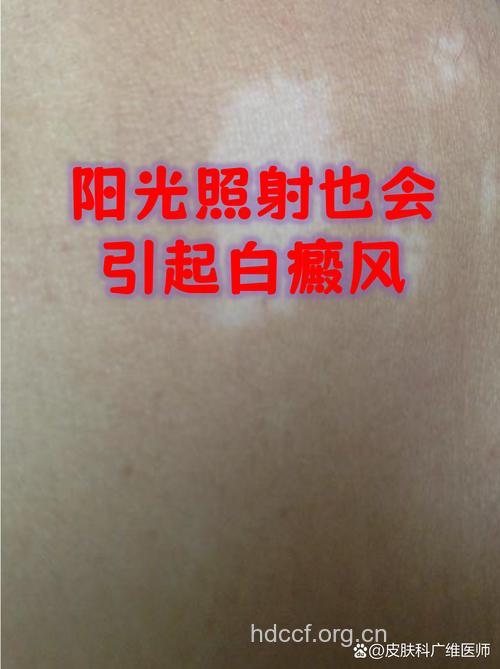 阳光暴晒会引发白癜风吗
