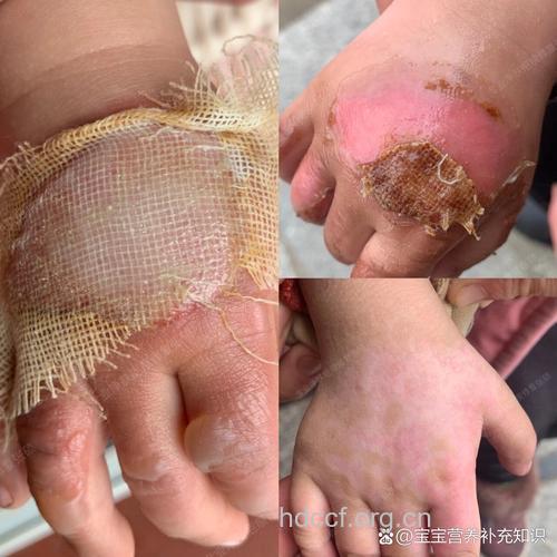 宝宝烫伤乱抹醋加深受伤程度