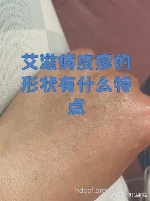 艾滋病患者早期症状表现