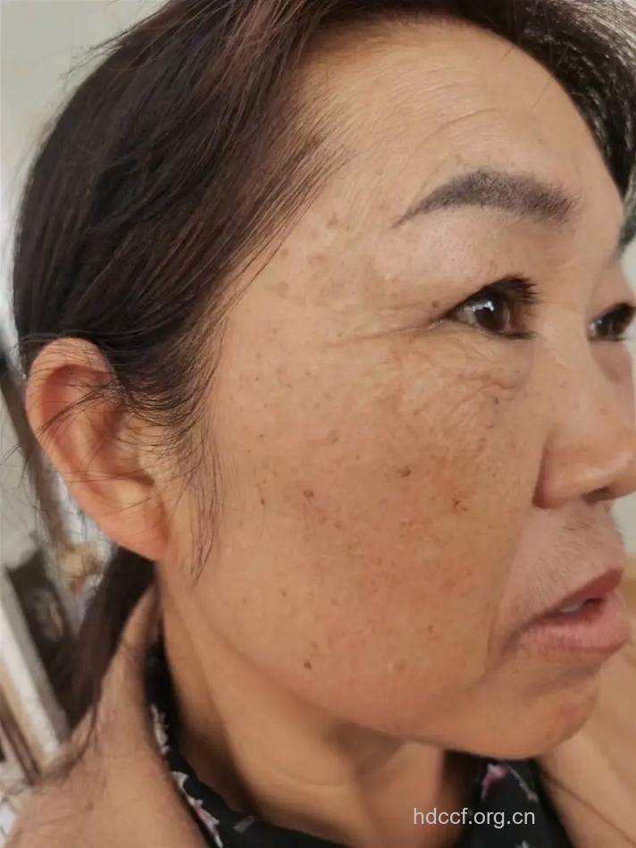 食盐过多造成女人脸部雀斑